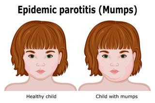 Mumps symptoms - HSE.ie