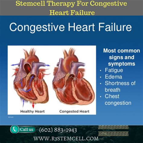 Symptoms of congestive heart failure in women