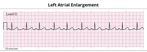 Left Atrial Enlargement Essentials | BM Birla Hospital Kolkata