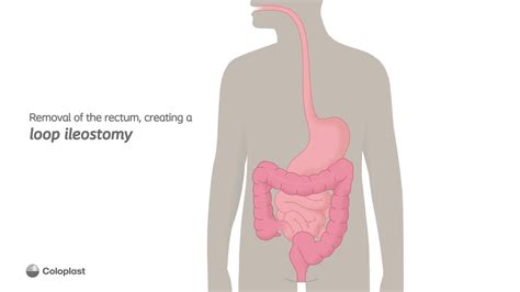 Creation of loop ileostomy by removing the rectum | Ostomy surgery | Coloplast India - YouTube