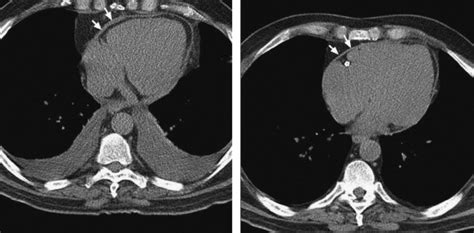 Pericardial Diseases: Constriction and Pericardial Effusion | Thoracic Key