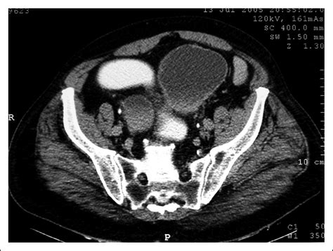 Distended urinary bladder and diverticulum—a rare cause of large-bowel ...