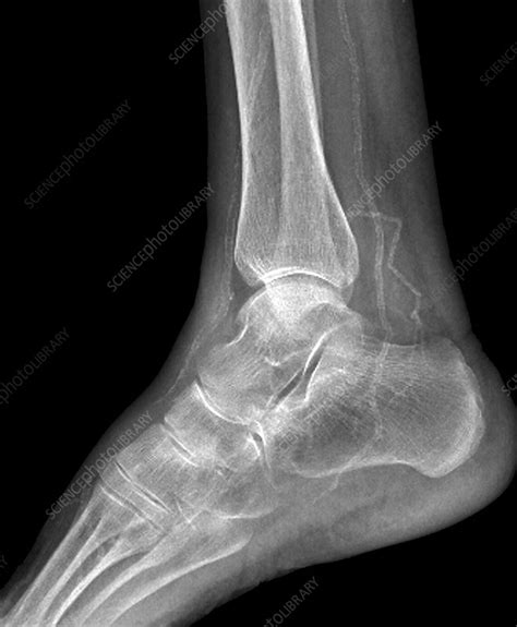 Calcified ankle arteries, X-ray - Stock Image - C026/9875 - Science Photo Library