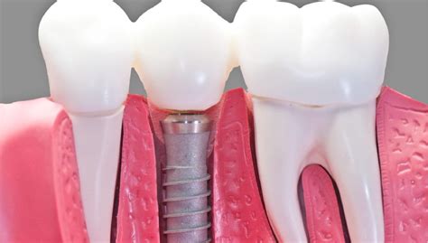 What To Expect During Dental Implant Recovery