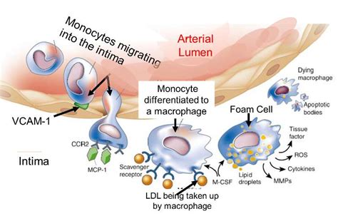 Pathogenesis of Atherosclerosis