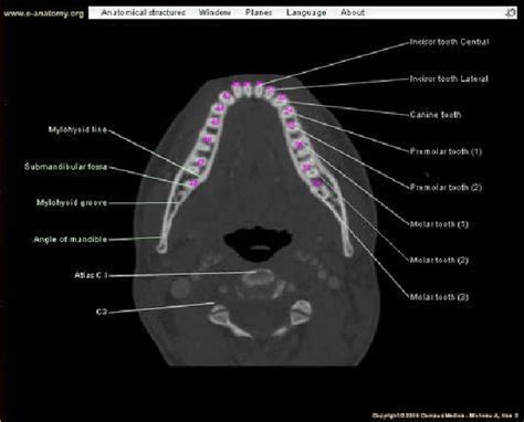 CT image for the mandible [25] | Download Scientific Diagram