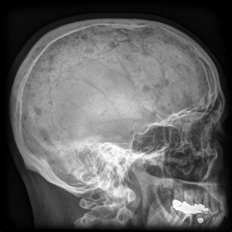 Multiple myeloma differential diagnosis - wikidoc