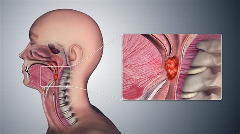 Throat Cancer: Early Signs, Symptoms, Causes, and Prognosis - Remedies Lore