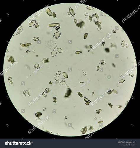 28 Calcium Oxalate Mono Hydrate Images, Stock Photos & Vectors ...