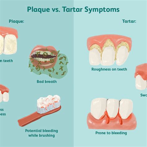 List 96+ Pictures Pictures Of Tartar On Teeth Stunning