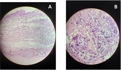 Placental histology Case 1. A. Low resolution: acute chorioamnionitis ...