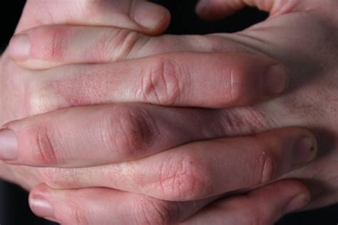 First Symptoms of Systemic Scleroderma | Livestrong.com