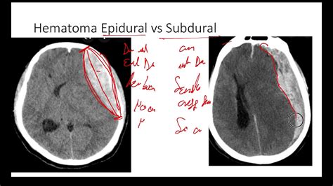 Subdural Vs Epidural Hematoma Presentation