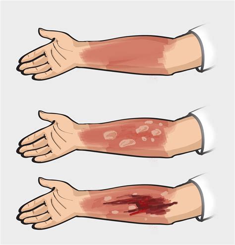 Emergency Burn Treatment - Beaumont Emergency Hospital