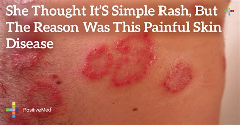 Skin Cancer Rash On Back