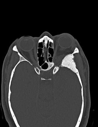 Hyperostosis of the skull (differential) | Radiology Reference Article | Radiopaedia.org