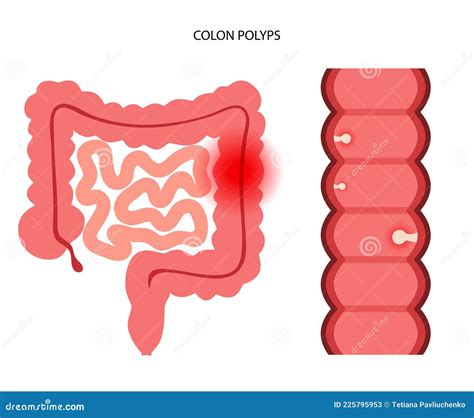 Polyp In The Intestine. Polyp In The Colon. Vector | CartoonDealer.com #58058732