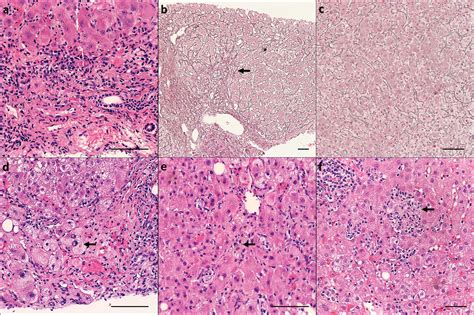 Liver Fibrosis Helps to Distinguish Autoimmune Hepatitis from DILI with ...