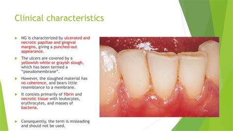 Necrotizing periodontal disease