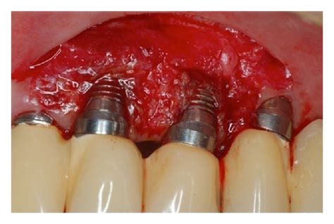 Recipient site prepared to receive the free gingival graft. | Download ...