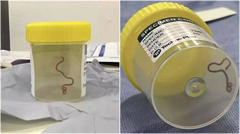 Physician Removed Live Worm From Australian Woman’s Brain - The Morning News