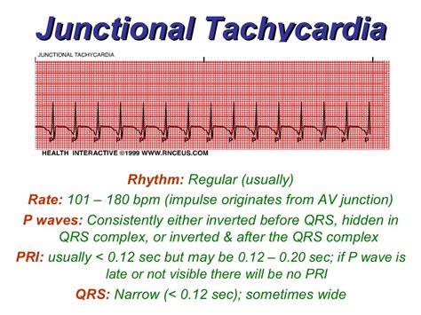 Junctional Rhythms - BMH/Tele