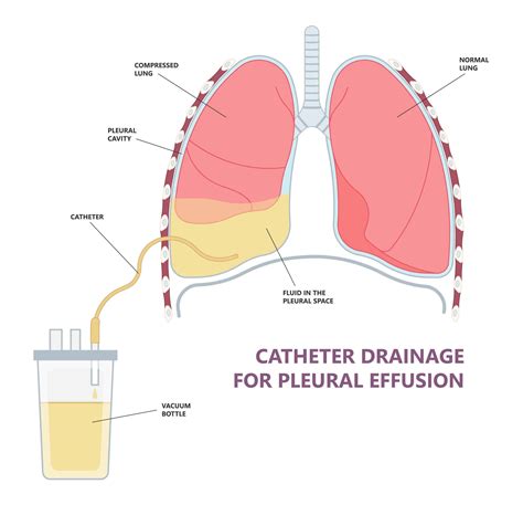 Indwelling Pleural Catheter in Singapore - Dr Akash Verma