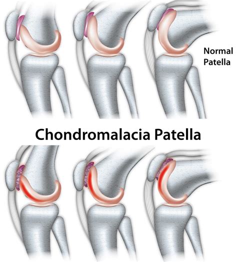 Patellofemoral Chondromalacia Offers Cheap, Save 42% | jlcatj.gob.mx