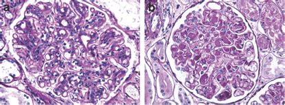 Membranoproliferative glomerulonephritis. Another common pathologic ...