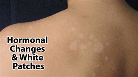 Causes White Spots On Skin