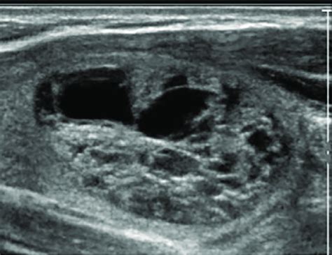 Thyroid Goiter Ultrasound