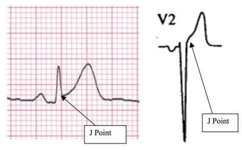 EKG Criteria for Fibrinolysis: What’s Up with the J Point? - The Western Journal of Emergency ...