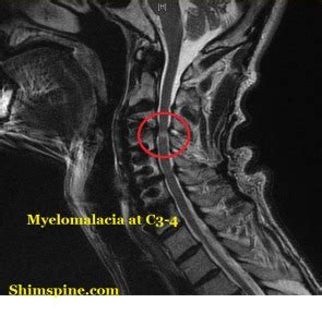 spinal cord compression Archives - Shim Spine