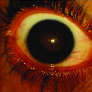 Anterior segment photograph of the right eye showing posterior synechiae. | Download Scientific ...