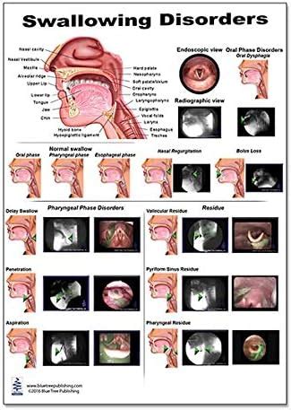 Amazon.co.jp: スワロー障害 解剖学ポスター 12x17インチ 口腔鏡 口腔障害 鼻腔調節 : ホーム＆キッチン