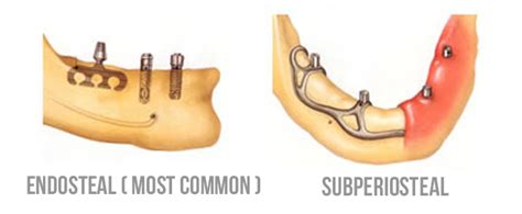 What types of dental implants can be used for your case