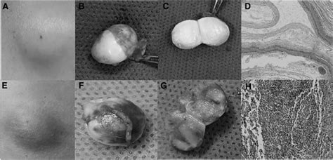 (A) The appearance of an uninfected epidermoid cyst. (B) Gross surgical ...