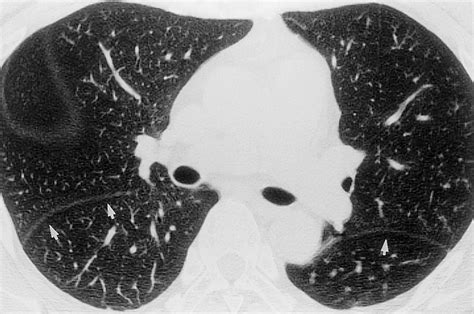 Radiographic and CT Appearances of the Major Fissures | RadioGraphics