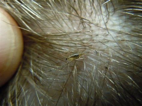 Lice eggs (nits) are tiny eggs that will later hatch into lice. To treat head lice completely ...