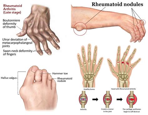 Progressive damage of bones due to Rheumatoid Arthritis | Rheumatoid arthritis, Arthritis ...