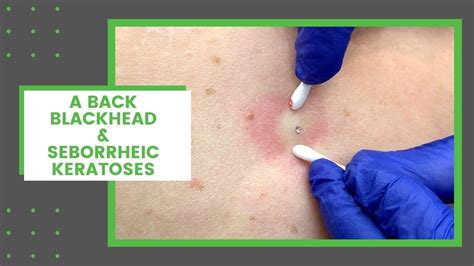 A Back Blackhead & Seborrheic Keratoses | Dr. Derm - YouTube