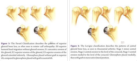 Management of Glenoid Bone Loss in Reverse Shoulder Arthroplasty | Acta of Shoulder and Elbow ...