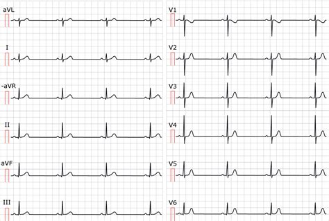 Sinus Bradycardia