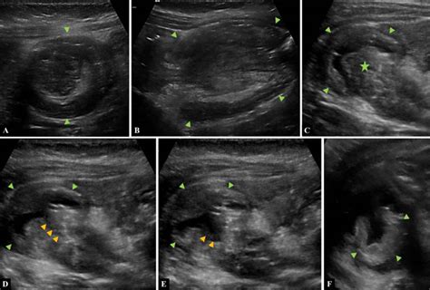 Case of a 9-month-old infant with abdominal distension and currant... | Download Scientific Diagram