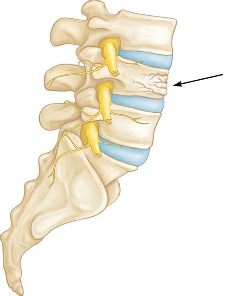 L1 Compression Fracture - Figgymcfatty