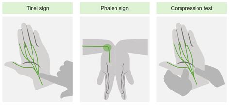 Carpal Tunnel Syndrome Test