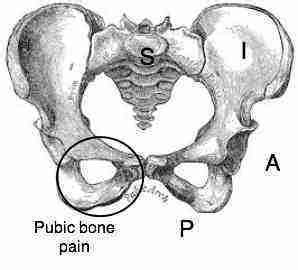 Pubic bone pain is a common complaint at the chiropractic clinic.