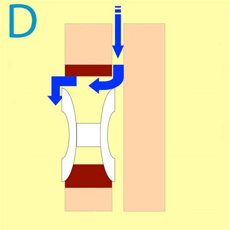 Stimmprothese » Shunt Insufficiency