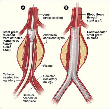 Abdominal Aortic Aneurysm Endovascular Repair (Stent Graft ...