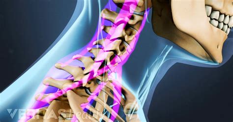 Neck Strains and Sprains Video